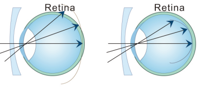 More conducive to slow control of myopia deepening